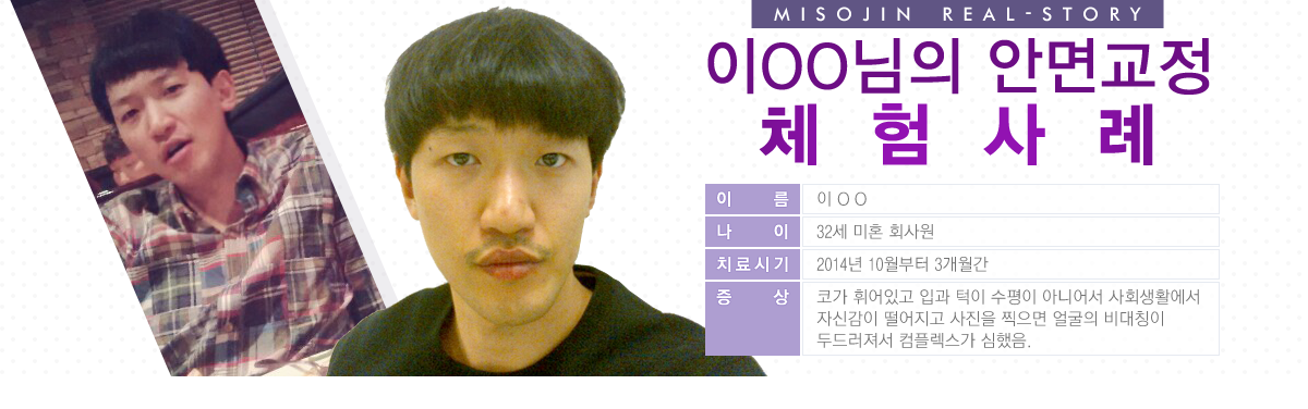 이OO님의 안면교정 체험사례